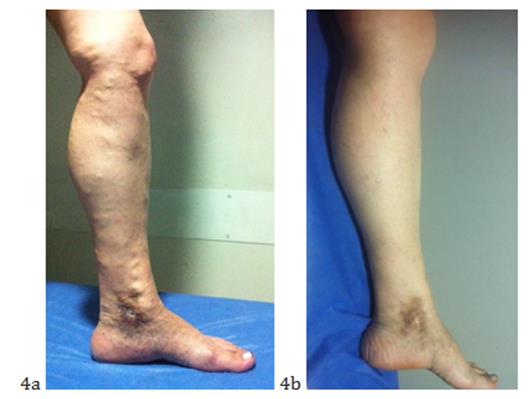 Figure 5: Results of radiofrequency treatment.