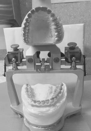 Figure 2: Customized Broadrick's occlusal plane analyzer to know the posterior plane of new crowns and curve of Spee.