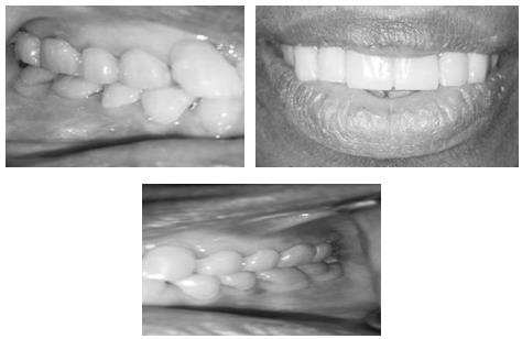 Figure 4: Provisional single crowns at increased vertical (Provisional restorations were placed after a trial period of the removable occlusal splint).