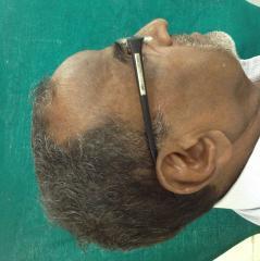 Figure 10: Post-op Patient Front Profile.