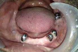 Figure 2: Primary copings cemented over the abutments.