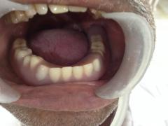 Figure 8: Intra-oral Trial of Metal Framework. The metal framework along with secondary copings had to be placed on the master cast, it had to be covered with wax and the trial denture base had to be fabricated with chemically cured acrylic resins after applying separating media over the master cast. The placement of the wax over the secondary copings helped in the easy separation of the abutment copings from the trial denture base at the time of the dewaxing. Occlusion rims were also fabricated over the trial denture base. The artificial teeth were selected and arranged on the record bases for a trial denture arrangement and they were evaluated intraorally for phonetics, aesthetics, occlusal vertical dimension and centric relation. After the wax up, the dentures were processed, finished, polished and delivered to the patient (Figures 9-11). The patient was scheduled for follow-up visits every 3 months and he reported no complaints during the 2 years of follow-up.