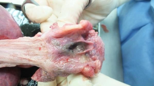 Figure 3: Corrosive necrotic changes of the esophagus.