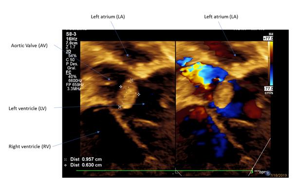 Figure 1: Two-dimensional subcostal axis and color Doppler where tumor is observed to the left ventricular outflow tract.