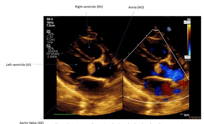Figure 2: Long two-dimensional axis and color Doppler where tumor is displayed.