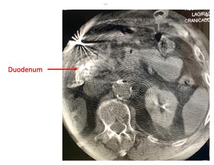 Figure 3: Cone beam CT depicting enhancement of the duodenum upon contrast injection into the GDA.