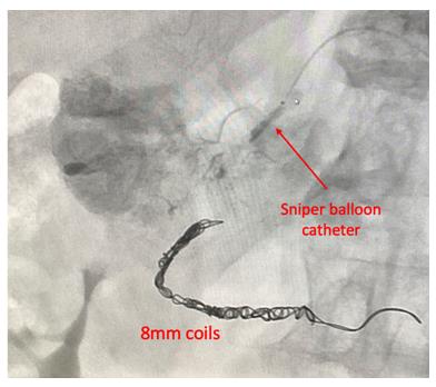Figure 4: Cone beam CT depicting enhancement of the HCC upon contrast injection into the GDA.