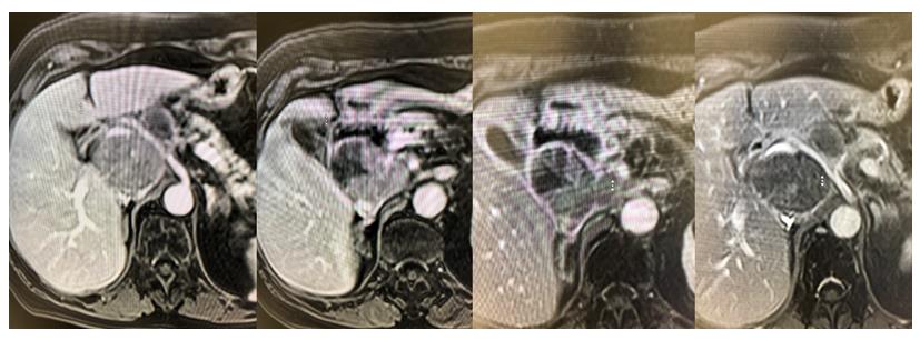 Figure 6: T1 weight MR imaging depicting a decrease in tumor size on one-month post procedure follows up.