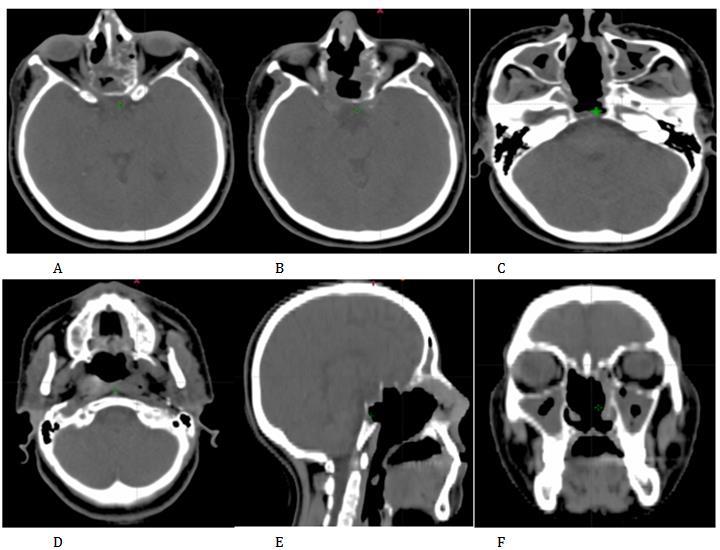 Figure 4: MRI sections in the axial plane sequence T1 (A), sequence T2 (B,C,D), frontal plane (E) and sagittal plane (F) showing invasion of the optic nerve, sphenoidal bone body and hard palate.
