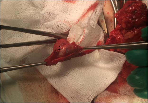 Figure 5: Intraoperative photo. 1 - left testicle, 2 – adhesions.
