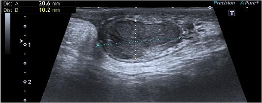 Figure 6: Patient B. Sonographic picture of the left testicle in 2 years and 6 months after surgery.