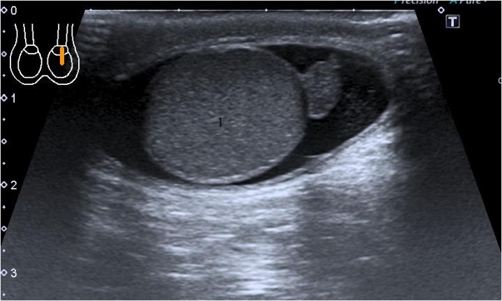 Figure 7: Sonographic picture before surgery. 1- left testicle, 2- serous fluid in the scrotum cavity. Physical examination: External genitalia are male- shaped, normal; testicles in the scrotum, of equal size (about 2.5 x 1.2 cm). There is an expansion (up to 1.5 cm) of the left external inguinal ring with hernial protrusion of 2.0 x 2.0 cm, soft-elastic consistency which is freely and painlessly set into the abdominal cavity. A symptom of cough push is positive. On the left, a moderate fluid accumulation in membranes of the left testicle is palpable (volume decreases with compression). There is no hernial protrusion on the right; the external ring of the inguinal canal is not extended. Postoperative scars on the anterior abdominal wall are normotrophic, pale, there is no inflammation. Intraoperatively: The front wall of inguinal canal was exposed and opened by skin incision in layers in the left inguinal region at the projection of inguinal canal. As soon as the spermatic cord did separated, surgeons immediately paid attention to the fatty tissue in the spermatic cord resemble the large omentum. During mobilization of the spermatic cord, a rough cicatricial- adhesive process was revealed in the internal inguinal ring. When the adipose tissue was separated, a strand of large omentum about 10x15 cm in size was found; it was fused to the peritoneum by circular cicatricial bands in the projection of internal inguinal ring (Figures 8 & 9). Elements of the spermatic cord (spermatic cord and testicular vessels) were separated. Resection of the greater omentum was made within the margins of free tissues (a resected part was sent for histological examination), the remaining part was placed back into the abdominal cavity. A purse string was put on the peritoneum of internal inguinal ring. A “window” was made in testicular membranes, and clear liquid of about 3.0 ml was obtained; the testicle was put into the scrotum. Hemostasis during surgery. Plasty of the inguinal canal by Martynov, sutures in layers, iodine, aseptic adhesive bandage.