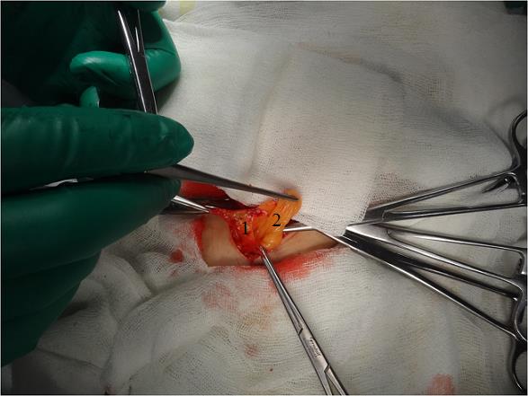 Figure 9: Intraoperative photo. 1- Hernial sac, 2 - A strand of the omentum.