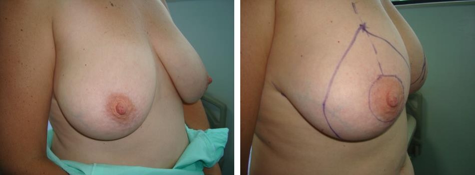 Figure 1: a) Before marking b) Evaluation of skin excess c) Final marking.