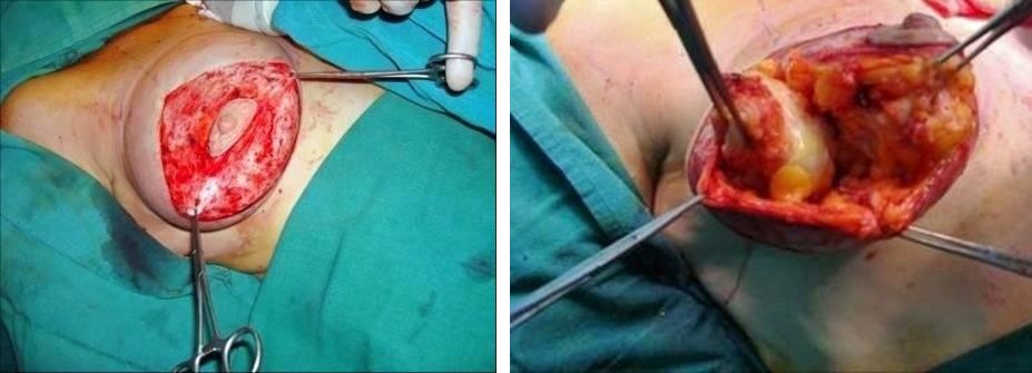 Figure 2: a) after de-hepitelialization b) lateral volume reduction c) medial volume reduction d) the central block is mobilized e) the central block is ready to be anchored to the fascia.