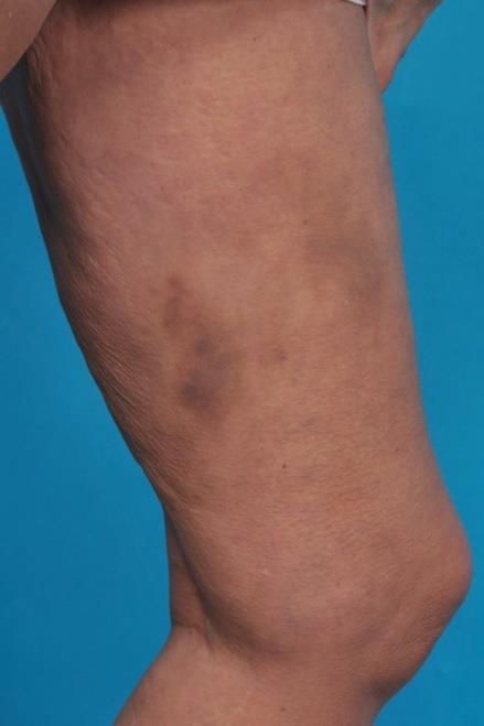 Figure 1: The bruises on her upper left leg.