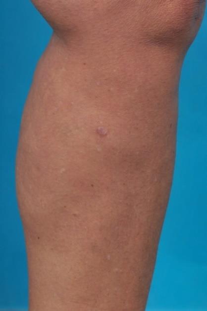 Figure 3: Hypertrofic scarring at the biopsy site (lower left leg), taken 1.5 years ago.