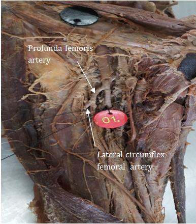 Figure 3: Branches of Lateral circumflex femoral artery from Femoral artery.