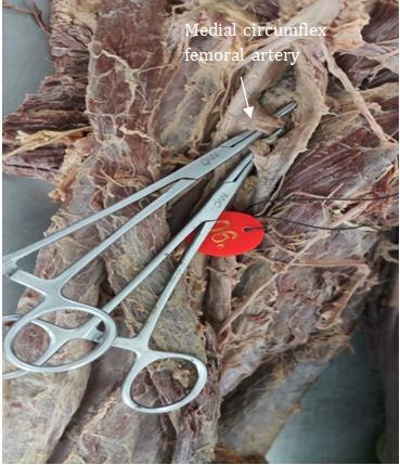 Figure 4: Medial circumflex femoral artery from Femoral artery.