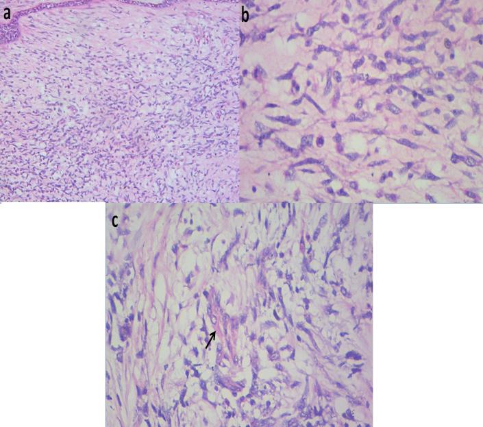 Figure 4: Photomicrograph showing areas with embryonal features: small round to spindle cells set in a myxoid stroma (a, X40; b, H&E X100). Rhabdomyoblasts are identified (c, H&E X100-black arrow).