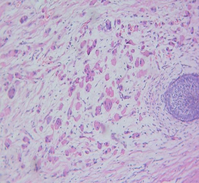 Figure 5: Photomicrograph showing an area with pleomorphic features: bizarre spindle shaped cells admixed with readily identifiable polygonal and pleomorphic rhabdomyoblasts (H&E X100).