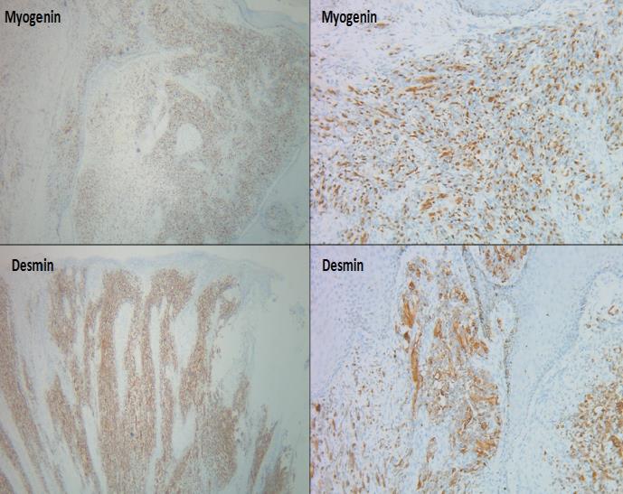 Figure 6: Photomicrograph showing immunohistochemical features: tumor cells were positively stained with myogenin and desmin (Myogenin and Desmin immunostain X40 and X100).