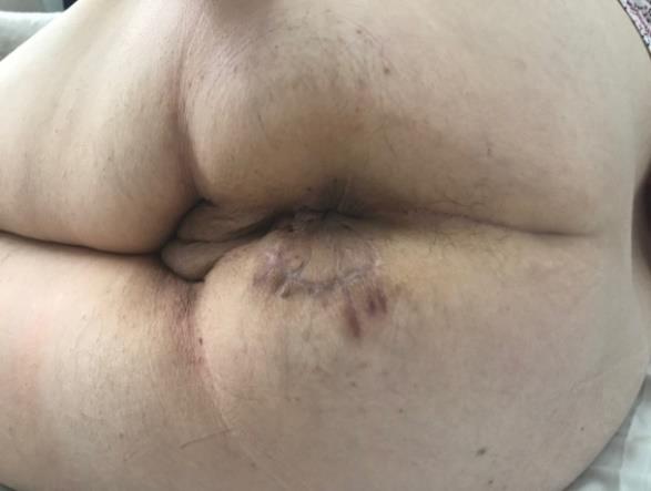 Figure 1: Preoperative status with firm nodule in the episiotomy scar.