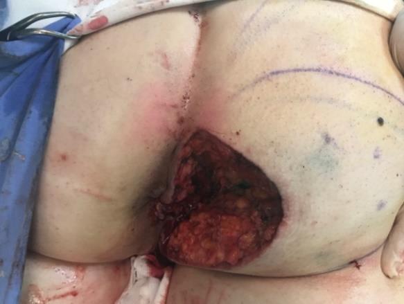 Figure 2: Radically excised tumor.