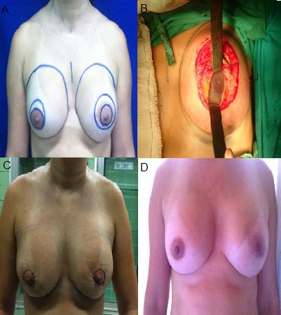 Figure 2: A: Deformity in the right breast and Asymmetry of persistent pain in the left breast. B: Intraoperative: implant incorrectly placed inverted covered by periprosthetic capsule in subglandular plane. C: Immediate postoperative breast reconstruction. D: Late postoperative.
