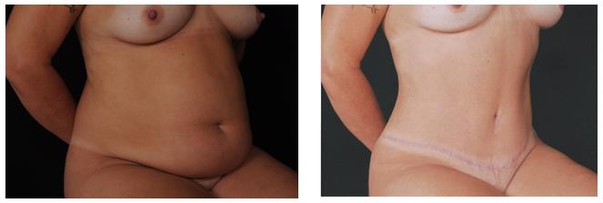 Figure 5: Case 4- a: Preoperative; b: Postoperative of 6 months.