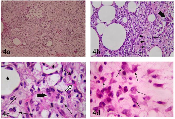 Figure 4: 4a: Photomicrograph of control group (I) showing a localized group of adipocytes and few fat cysts. Numerous inflammatory cells and blood vessels can also be seen. Notice: presence of large amount of connective tissue fibers. (H&E x100) 4b: Photomicrograph of control group (I) showing fat cysts surrounded by intense inflammatory infiltration. Spindle shaped fibroblasts can be seen (↑). Apoptotic cells and cellular debris are observed (thick arrow). Notice: numerous cells with foamy cytoplasm can be seen (arrow heads).(H&E x400). 4c: Photomicrograph of control group (I) showing adipocytes forming fat cyst containing cellular debris (star) and adipocytes with karyolitic nuclei (↑↑). Star-shaped preadipocyte with acidophilic cytoplasm and few fat droplets were also observed (white arrow). Notice! Presence of foam cells (↑) and multinucleated giant cells (thick arrow).(H&E x1000) 4d: Photomicrograph of control group (I) showing numerous spindle shaped cells with acidophilic cytoplasm (↑). Some of them contain small vacuoles. (H&E x1000).