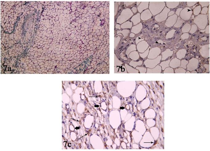 Figure 6: 6a: Photomicrograph of CAL group (II) showing many normal sized and shaped adipocytes with few numbers of degenerated fat cysts (star). Connective tissue septa (arrow heads) and blood vessels (↑) can be seen. (H&E x100) 6b: Photomicrograph of CAL group (II) showing multiple normal sized and shaped adipocytes, few fat cysts (triangles). The stromal vascular fraction contains few stromal cells (arrow heads) and blood vessels (star). (H&E x400).