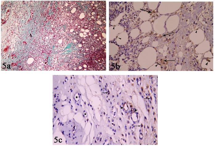 Figure 7: 7a: Photomicrograph of CAL group (II) showing few amount of collagen fibers surrounding normal sized and shaped adipocytes and blood vessels. (Masson’s Trichrome staining x100) 7b: Photomicrograph of CAL group (II) showing minimal caspase-3 positive reaction (arrow heads). (Caspase-3 immune histochemical staining x400) 7c: Photomicrograph of CAL group (II) showing moderate to severe positive VEGF reaction in reaction in blood vessels (thick arrow) and stromal cells (↑). (VEGF immune histochemical staining x400).