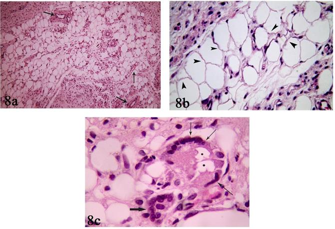 Figure 8: 8a: Photomicrograph of ALA group (III) showing normal sized and shaped adipocytes. Stromal fraction contains connective tissue fibers, inflammatory cells and many blood vessels (↑). (H&E x100) 8b: Photomicrograph of ALA group (III) showing adipocytes with irregular cell membranes (arrow heads). Connective tissue with stromal cells can also be seen.(H&E x400) 8c: Photomicrograph of ALA group (III) showing two multi nucleated giant cells (thin and thick arrows). One giant cell (thin arrow) contains fat droplets in its cytoplasm (stars). (H&E x1000).