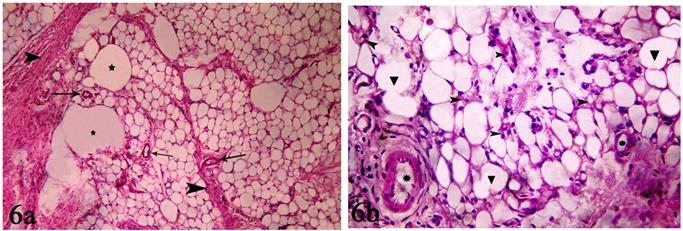 Figure 9: 9a: Photomicrograph of ALA group (III) showing moderate amount of collagen fibers surrounding areas of normal sized and shaped adipocytes forming septa.(Masson’s Trichrome staining x100) 9b:Photomicrograph of ALA group (III) showing mild mild caspase-3 positive immune reaction in some adipocytes (arrow head) and inflammatory cells (↑). (Caspase-3 immune histochemical staining x400) 9c: Photomicrograph of ALA group (III) showing moderate positive VEGF reaction in endothelium of blood vessels (arrow head) andstromal cells (↑). (VEGF immune histochemical staining x400).