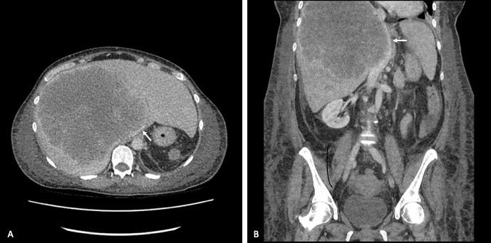 Figure 1: Axial (A) and coronal (B) CT scan images of the abdomen ten days prior to IVC stenting demonstrating the severe compression of the IVC (arrow).