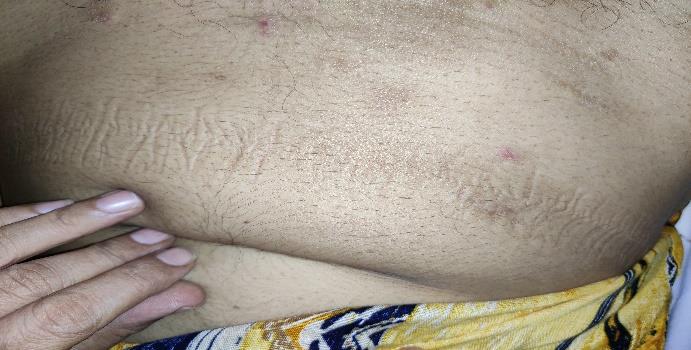 Figure 1: On Lower Abdomen.