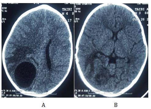 Figure 4: Axial CT (A): Pre-operative CT showing a large brain cyst in the right parietal lobe consistent with a hydatid cyst (B) postoperative CT showing no residual cyst.