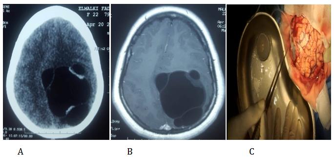Figure 5: Axial CT (A) and, T1-weighted axial MRI (B) showing: multiple intralesional well-defined cysts in the left fronto-parietal lobe (C): intraoperative view of multiple cyst.