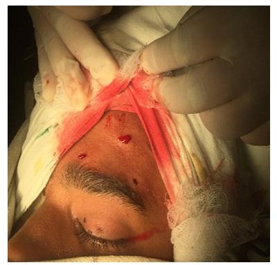 Figure 2: Marking the incision point.