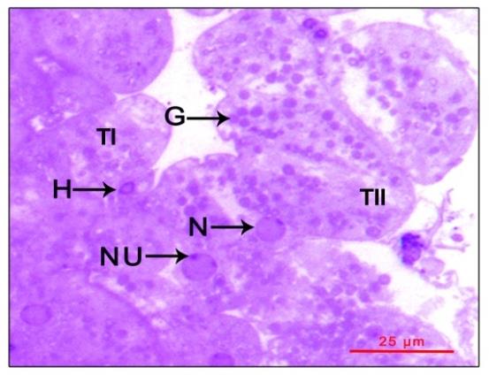 Figure 3: Loosely arranged type II cells filled with