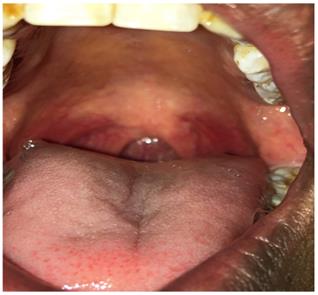 Figure 2: Oral cavity, teeth with absent uvula.