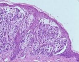 Figure 1: Spitz neoplasm with intradermal epitheloid and spindle cell component and attenuated superficial epidermis [6].