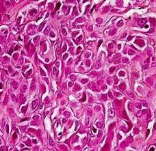 Figure 10: Spitzoid neoplasm with junctional activity, pigmentation, intradermal aggregates and epidermal prominence [14].