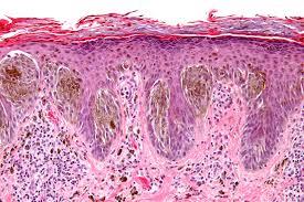 Figure 2: Spitz nevus with upper dermal aggregates of pigmented, epitheloid cells, stretched out epithelium with hyperkeratosis [7].