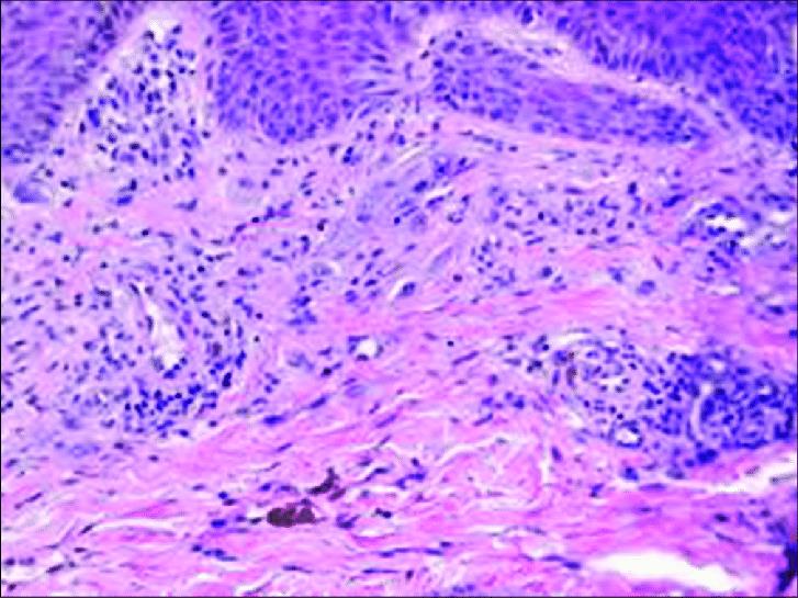 Figure 5: Spitzoid neoplasm with atypical melanocytes, enlargement, hyperchromasia, pigmentation, nucleolar prominence and dermal dispersion with junctional activity [10].
