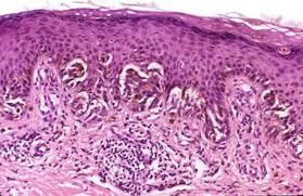 Figure 7: Spitzoid neoplasm with anisocoria, carinomegaly, atypical melanocytes with vesicular nuclei and prominent nucleoli [12].
