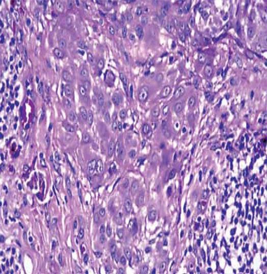 Figure 8: Spitoid neoplasm with a dense dermal exudation of atypical melanocytes, significant invasion of the dermal-epidermal junction, pigmented cell clusters and epidermal enhancement [12].