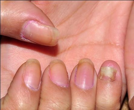 Figure 1: Nail plate on the right little finger In the dermoscopy examination we found vasodilatation of the bed vessels, without other findings. Also, mycological studies (direct and cultures) were performed with negative results. A chest x ray showed no abnormalities and a blood lab test informed: RBC, WBC, platelets, hemoglobin, hematocrit and hepatogram within normal values. A biopsy of the nail bed was considered. The anatomopathological report showed the presence of tortuous vasodilation of capillaries (Figure 2) and neutrophil microabscesses (Figure 3).