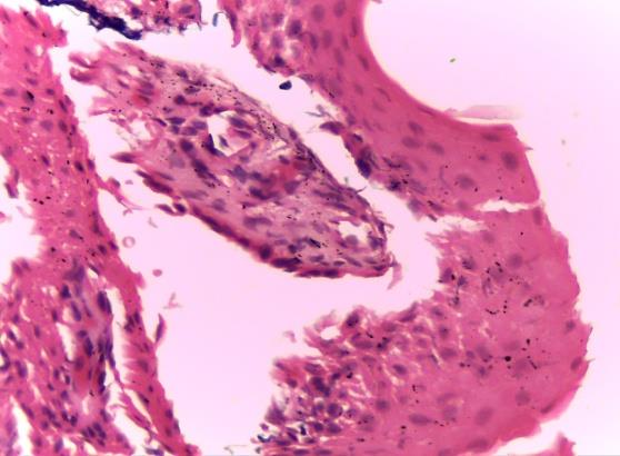Figure 2: Presence of tortuous vasodilation of capillaries